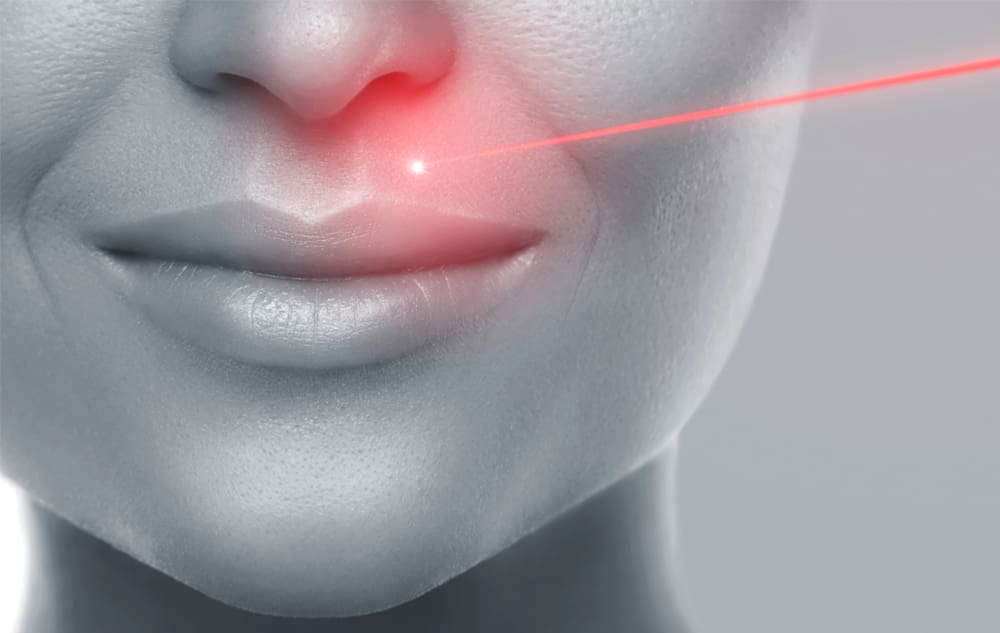 laser hair removal